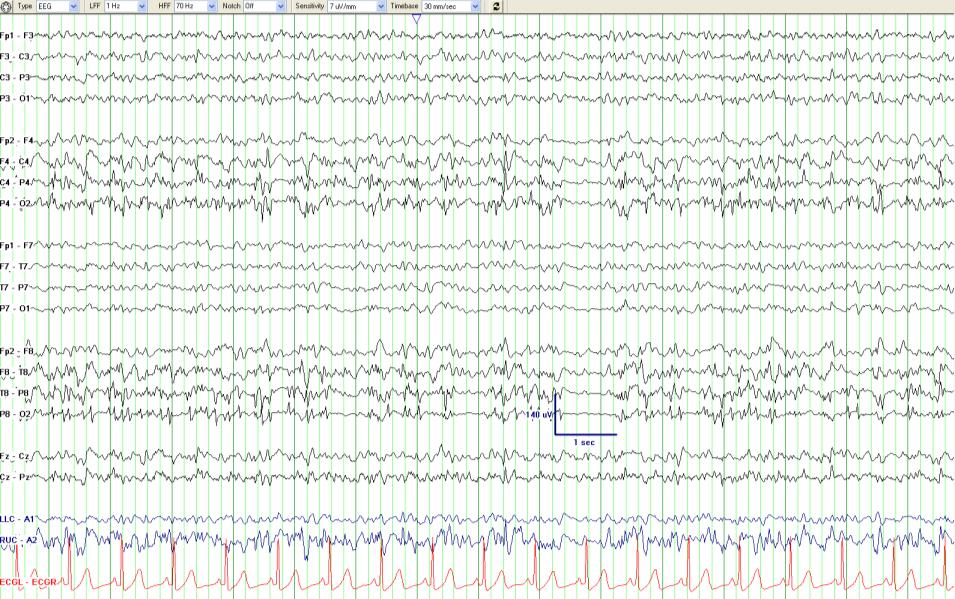 EEG on midazolam gtt