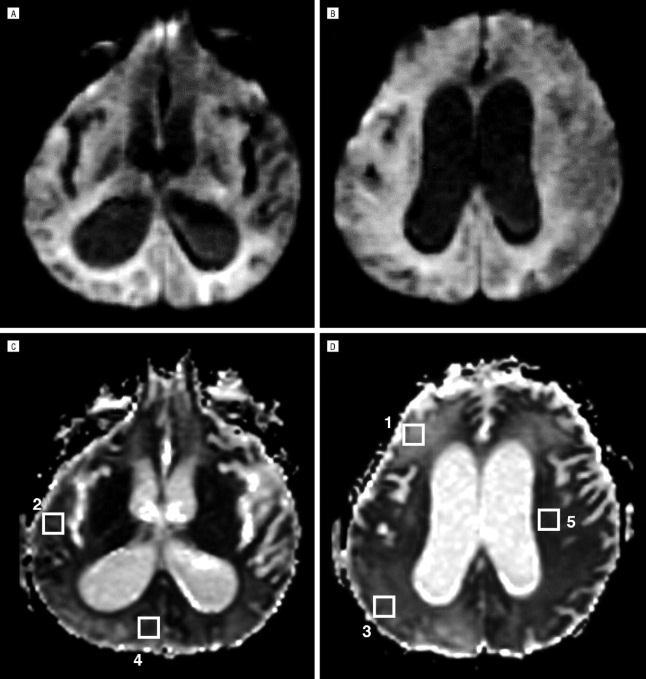 shows diffuse, gyriform cortical hyperintensities