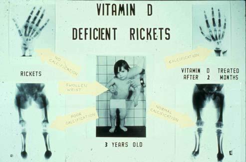 What Supports the Widespread Use of Vitamin D?