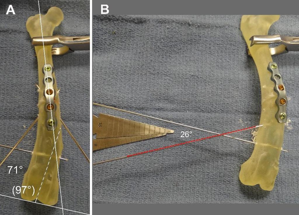 Figure 4 - At this point all rotational corrections have been made, and the CORA of the distal angular limb deformity can now be accurately determined (A).
