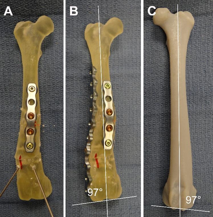 Figure 5 - After osteotomies are performed to the two respective K-wires parallel to the frontal plane (Figure 4B), the two ends of the bone are opposed and temporarily secured with two crossed