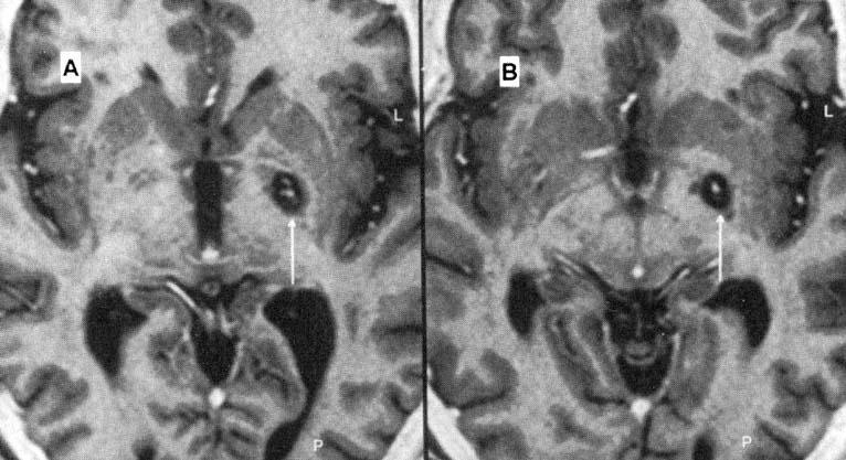 This is a post operative MRI of a patient whose PD was relieved by lesions of the internal part of the globus pallidus.