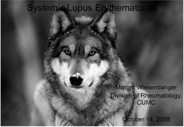Systemic Lupus Erythematosus SLE Epidemiology: who is at risk?
