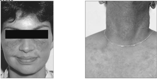 junction, inflammatory cells associated with a dermal appendage Cutaneous
