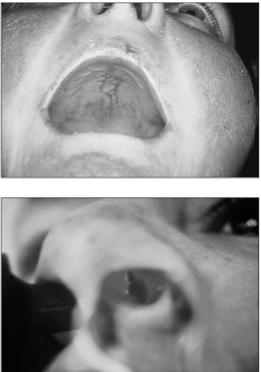 junction in non-sun exposed skin Hochberg Rheumatology Photosensitivity: a rash