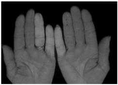 Popular lupus manifestations that failed to make the cut for criteria Constitutional features: fever, malaise, fatigue, anorexia/ weight loss, lymphadenopathy Raynaud s phenomenon Vasculitis