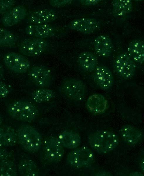 Autoantibodies against nuclear dots (AC-6) In immunofluorescence using, 6 20 differently sized granules which are spread over the cell nucleus (nuclear dots) can be seen in the nuclei during