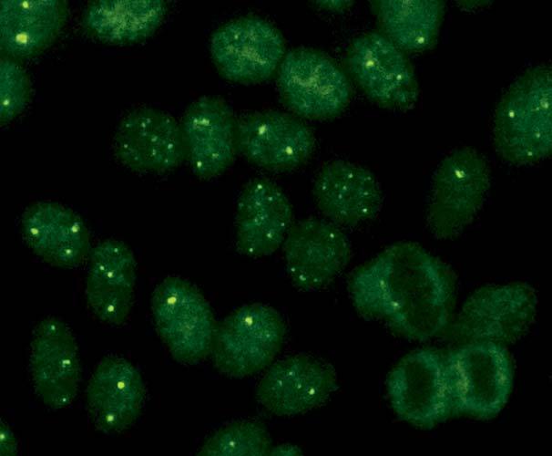 Autoantibodies against few nuclear dots (AC-7) In the immunofluorescence on, the pattern few nuclear dots merely shows 1 6 dots per cell nucleus frequently near the