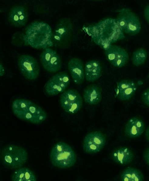 Autoantibodies against PM-Scl (AC-8) In the immunofluorescence test with, autoantibodies against PM-Scl exhibit a homogeneous fluorescence of the nucleoli with a simultaneous weaker, fine-speckled