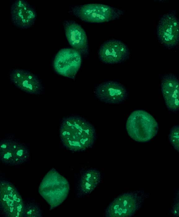 Autoantibodies against RNA polymerase I (AC-10) show a granular fluorescence of the nucleoli. The nucleoplasm is almost dark.