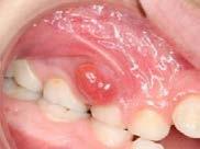 Intraoral Examination Results: Description: Emergent Referral: Pain/swelling; possible infection.