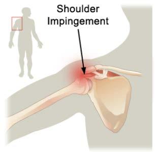 compresses the shoulder tendons, nerves, and ligaments.
