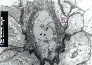 4 Transmission electron micrograph of caecal tonsil of an eight week-old chicken showing the M - cell (arrow) x 4200 N - Nucleus of M- cell The large lymphocyte had a small amount of cytoplasm with