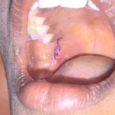 Oro-pharyngeal trauma due to tooth brush can lead to pharyngeal abscess, carotid artery thrombosis, mediastinitis or death 2,4,7.