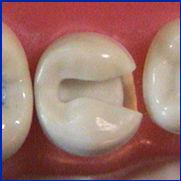 caries-susceptible areas Remove proximal contact area