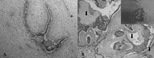 333 Fig. 3 Photomicrographs of the tumor. A. Cords and islands of odontogenic epithelium in a cell-rich ectomesenchyme tissue (HE stain, original magnification 100). B.