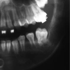 Note enamel matrix, osteodentin and epithelial tumoral cells in the inset (HE stain, original magnification 400). Fig. 4 Partial view of the panoramic radiograph at 2-year follow-up.