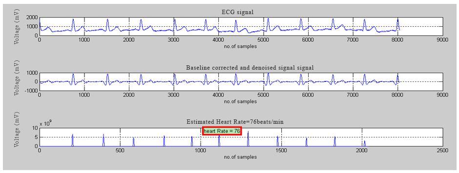 79 4.8.4 Preprocessing of ECG signal and Heart Rate Estimation In Figure 4.11 the top portion shows the ECG as originally obtained.