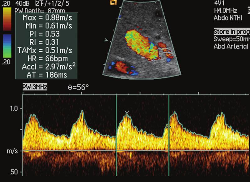 Conventional methods to assess hepatic artery patency include colour Doppler US, angiography and CT angiography.