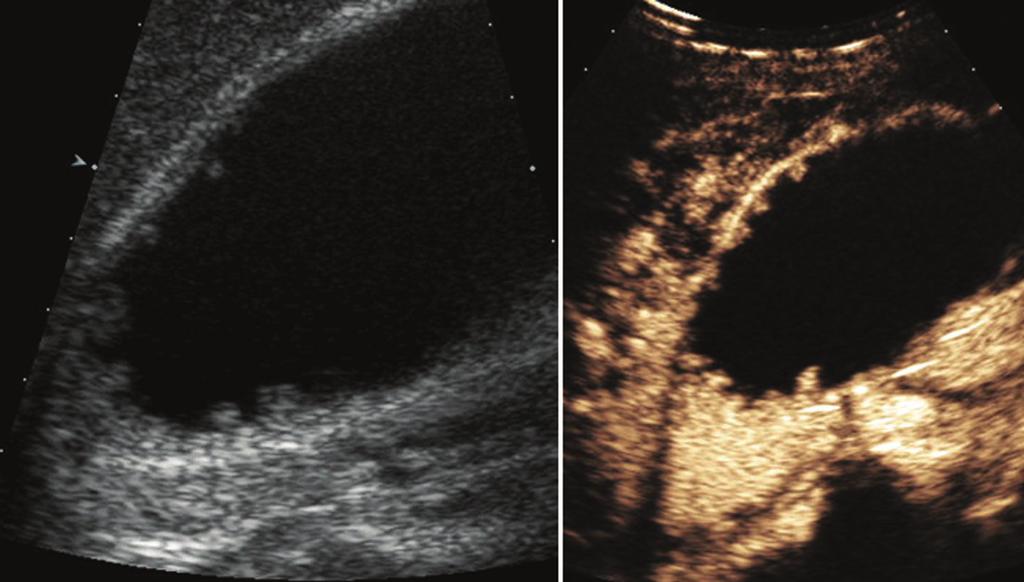 a Sludge seen on unenhanced US (left) is not vascularized (right).