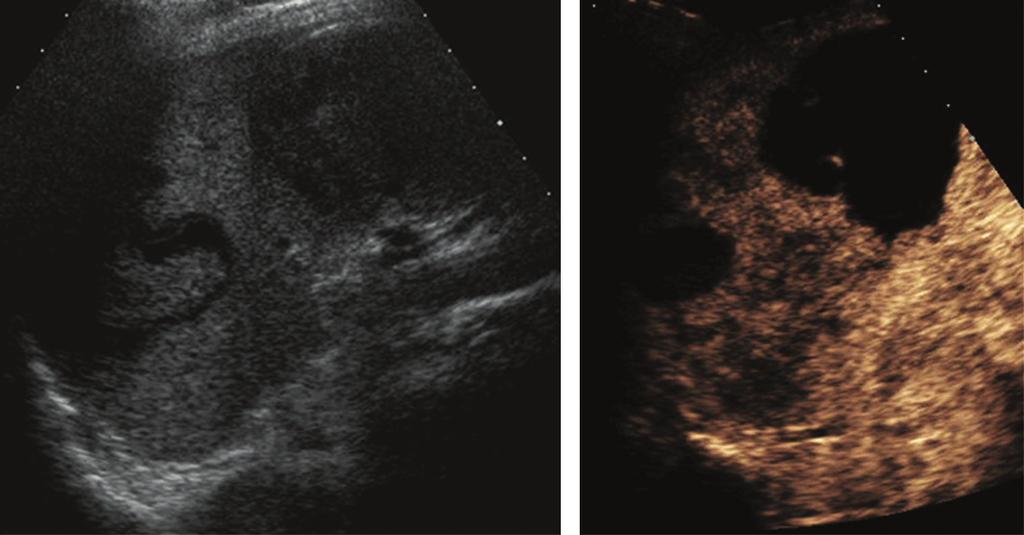 a Fig. 4 a, b. Splenic pathology revealed by contrast-enhanced US. a Splenic infarct in a patient with bacterial endocarditis: multiple areas of low enhancement are seen.
