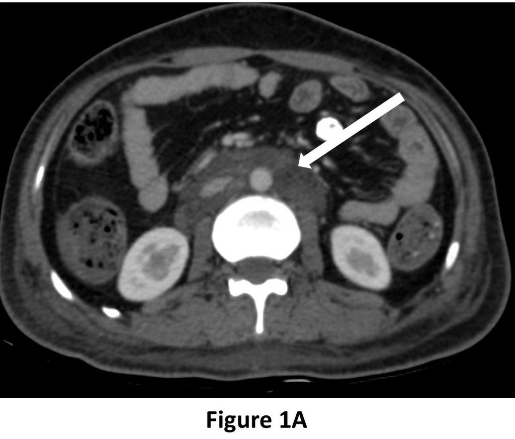 Figure 1A: CT scan of abdomen in hepatic venous phase, axial section showing non-enhancing lobulated hypodense tissue in the retroperitoneum (white arrow) completely encasing aorta & IVC.