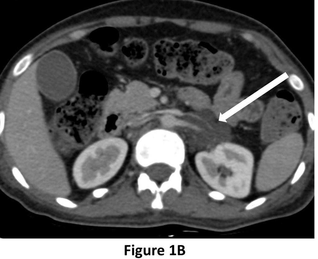 significant narrowing of left renal vein However, left kidney showed normal nephrogram. Case 2: A 2 years old male child presented with gradually progressive swelling of abdomen and right lower limb.