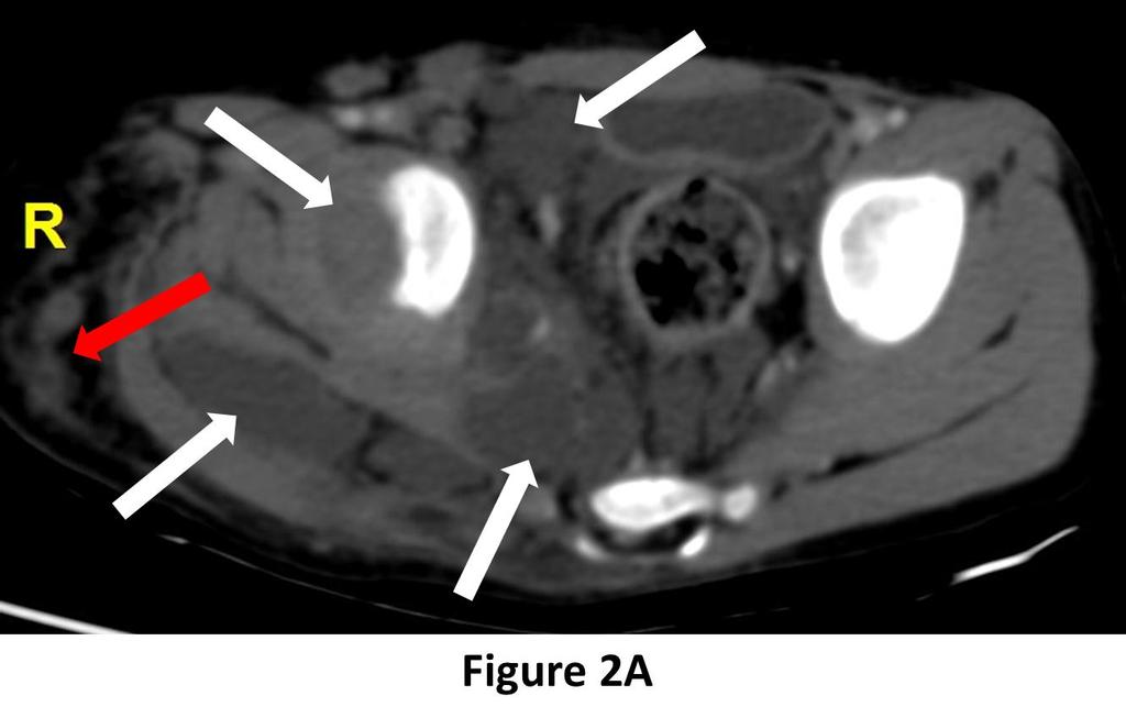 Figure 2A: CT scan of abdomen & pelvis in hepatic venous phase, axial section showing multiple non-enhancing fluid density collections involving muscles of right thigh and in extraperitoneal tissues