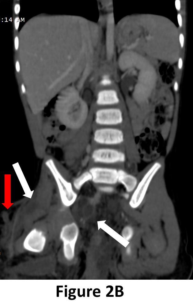 Figure 2B: CT scan of abdomen & pelvis in hepatic venous phase, coronal reconstruction showing multiple nonenhancing fluid density collections involving muscles of right thigh and in extraperitoneal
