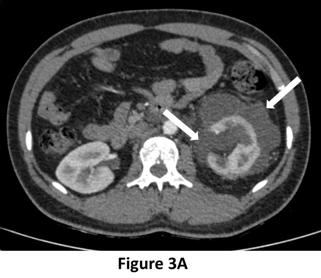 Figure 3A: CT scan of abdomen & pelvis in nephrographic phase, axial section showing loculated, fluid density collections in the peripelvic & perinephric space (white arrows) with suboptimal