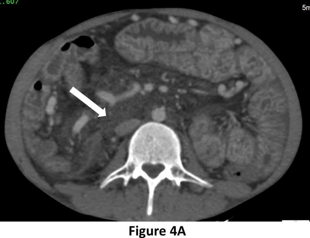 Figure 4A: CT scan of abdomen & pelvis in hepatic venous phase, axial section showing diffuse mesenteric haziness with