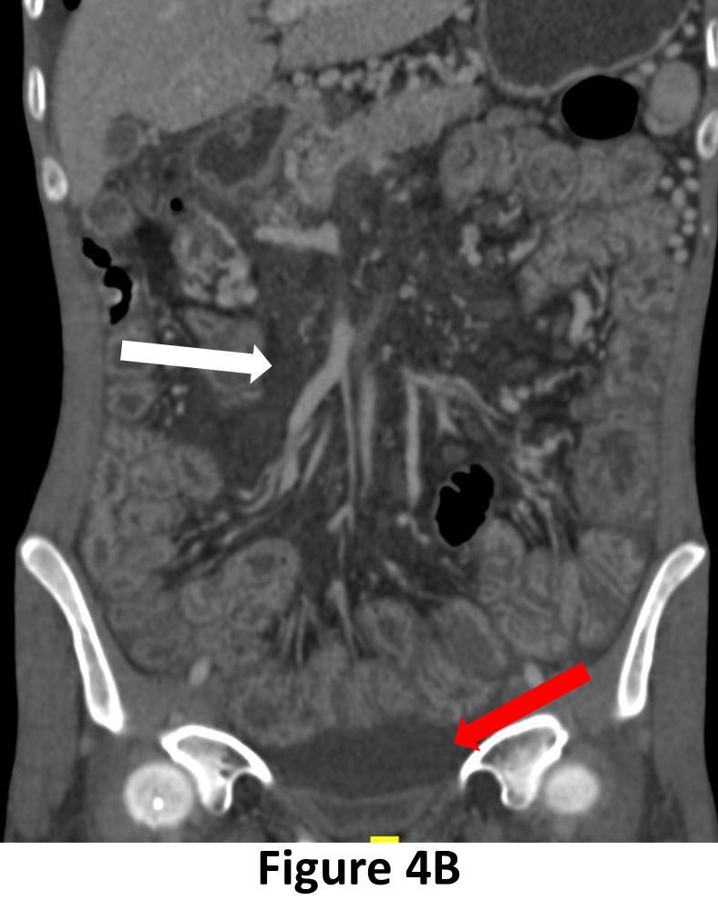 Figure 4B: CT scan of abdomen & pelvis in hepatic venous phase, coronal reconstruction showing diffuse mesenteric