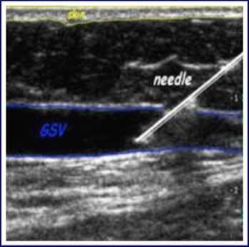Varicose Vein Procedures Ultrasound Guided Injection Sclerotherapy Venous Disease Treatment