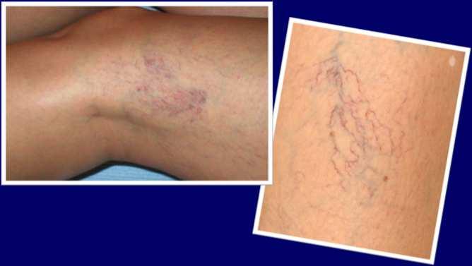 Varicose Veins What Are They? Spider Veins Reticular Veins Varicose Veins Venous Ulcers Spider Veins What Are They?