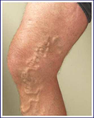 Varicose Veins Venous Ulcers What Are They?