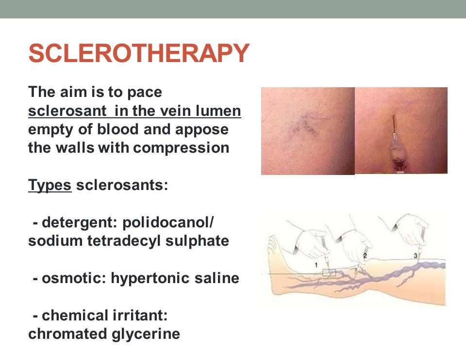 Indications for Treatment Pain and edema Superficial thrombophlebitis Venous ulceration Cosmetic concerns Bleeding varicosities Injection Sclerotherapy Injection of a liquid poison into the