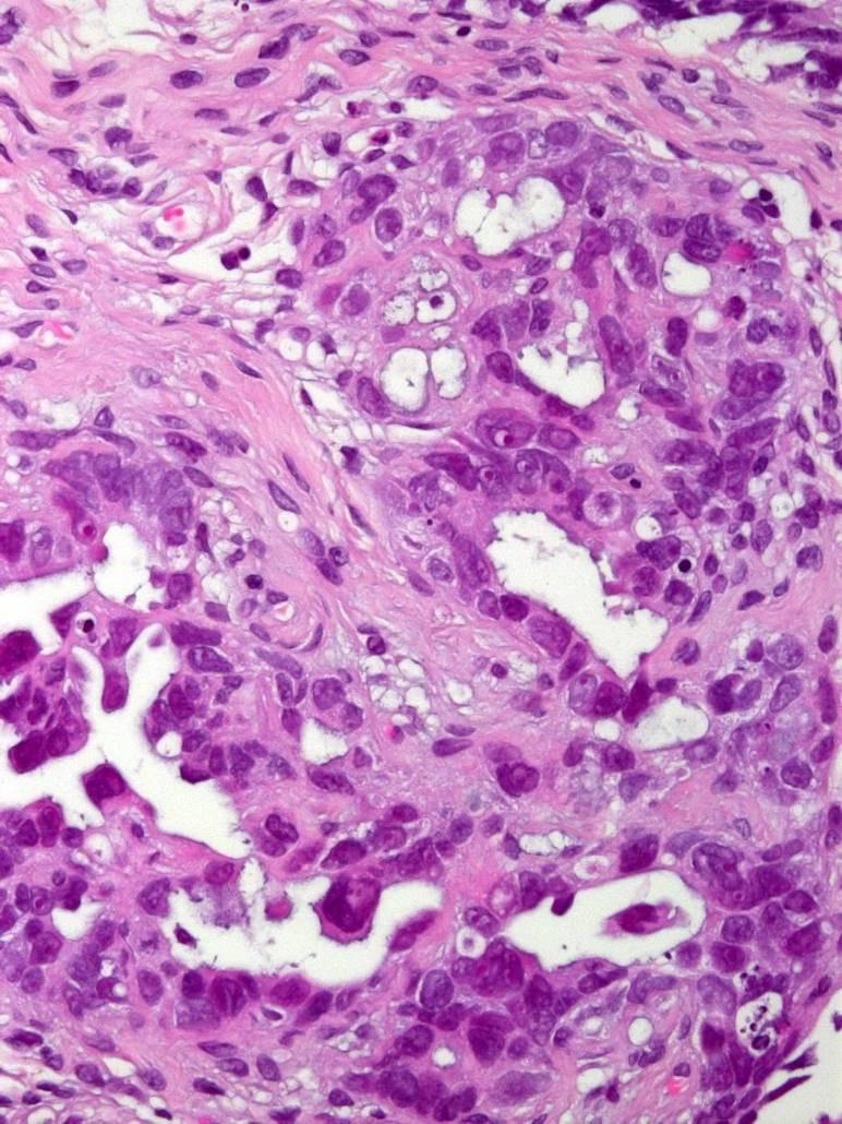 Serous tubal intraepithelial carcinoma Tubal epithelial alterations High grade atypia of the epitehlium Loss of polarity Mostly