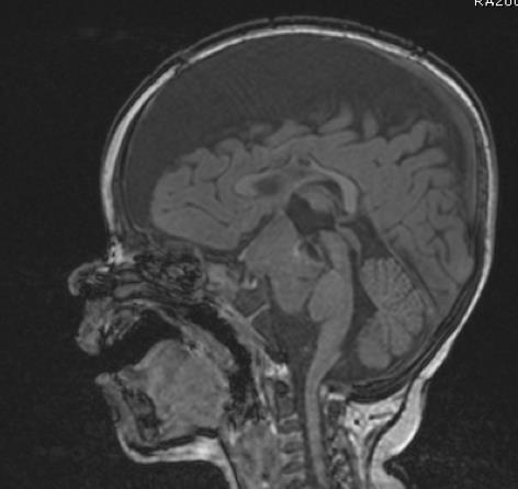 Immediate postoperative MRI Initially 90% improvement