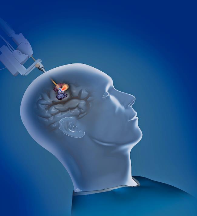 MRgLITT is rapidly gaining in popularity as a new alternative to craniotomy for tumors