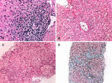 Figure 7 Reurrent hepatitis C virus infetion in the liver allograft. (A) Portal inflammation with interfae ativity and mild bile dut injury (H&E 6200).