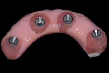 12 Definitive maxillary complete denture and definitive implant-supported complete denture 4 months