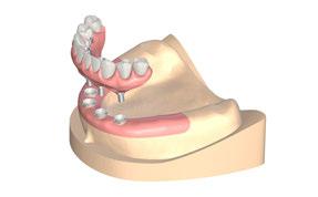 Additionally, forward all essential information to the dental lab (vertical dimension