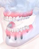 Discover the new Straumann option in the edentulous treatment portfolio: Include the Straumann Standard Plus