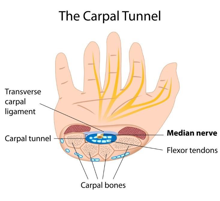 NEW Carpel tunnel It s a tunnel formed between the concavity of the carpal bones and a ligament covers it which is the