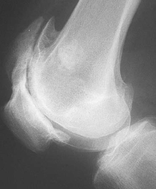 Knee radiograph showing hypertrophic OA features.