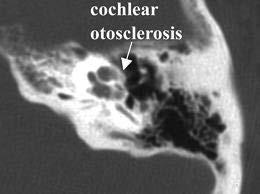 What is Otosclerosis? A disorder affecting collagen Cause?