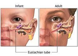 Eustachian tube dysfunction air in