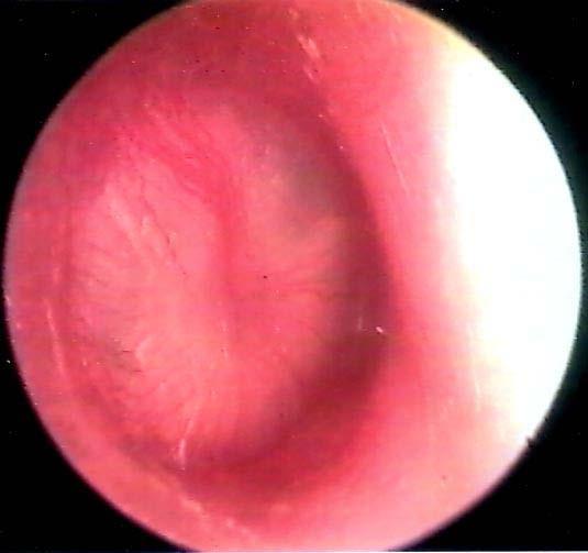 Purulent ear discharge