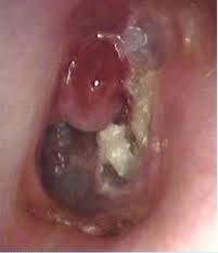 Chronic Suppurative Otitis Media Chronic- long-standing Suppurative formation of pus or