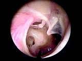 Safe Ear and Unsafe Ear Perforation in pars